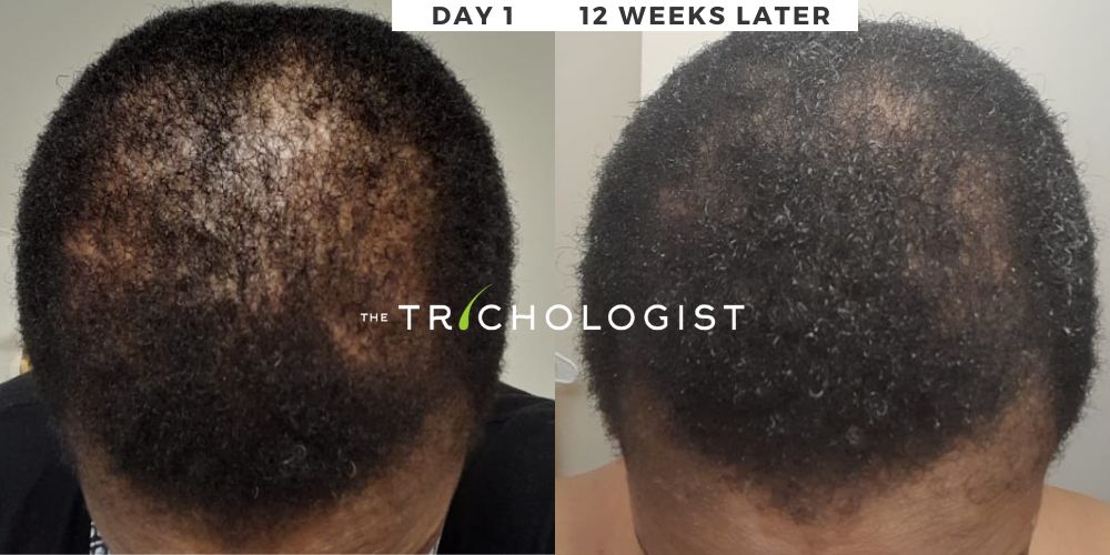 Atilola The Trichologist - Client Testimonial 2